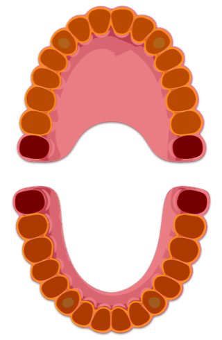 2 impianti in arcata superiore, 2 impianti in arcata inferiore con Attacchi Sferici per le Protesi Rimovibili